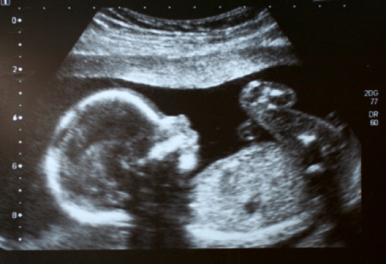 Echographie